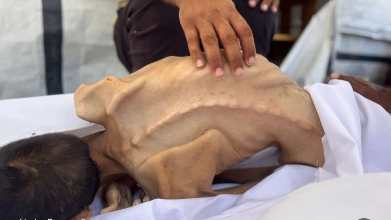 La familia de Adel Fawzi Madi lo vio transformarse en un esqueleto. El asedio impidió el acceso a tratamiento, alimentos y agua limpia